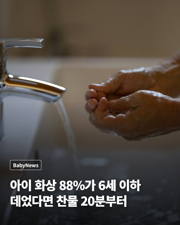 아이 화상 88%가 6세 이하… 데었다면 찬물 20분부터