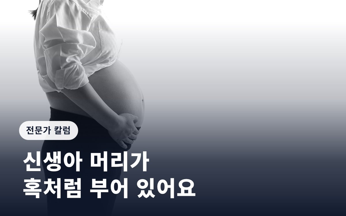 [임신영 칼럼] 신생아 머리가 혹처럼 부어 있어요