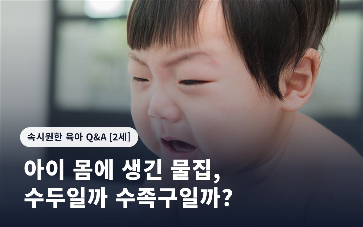 아이 몸에 생긴 물집, 수두일까 수족구일까?